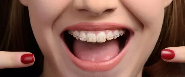 image-1 Neden Diş Teli Kullanmalıyız?