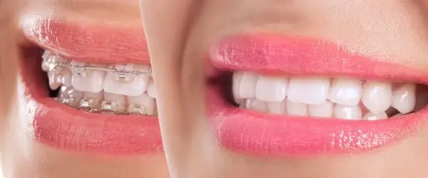 image Neden Diş Teli Kullanmalıyız?